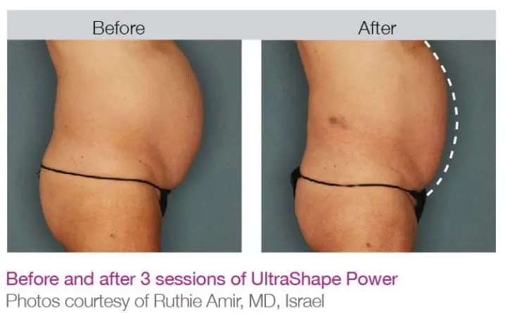 UltraShape-Power-Before-and-After Ultrashape Power Before and After Pictures Charleston, S