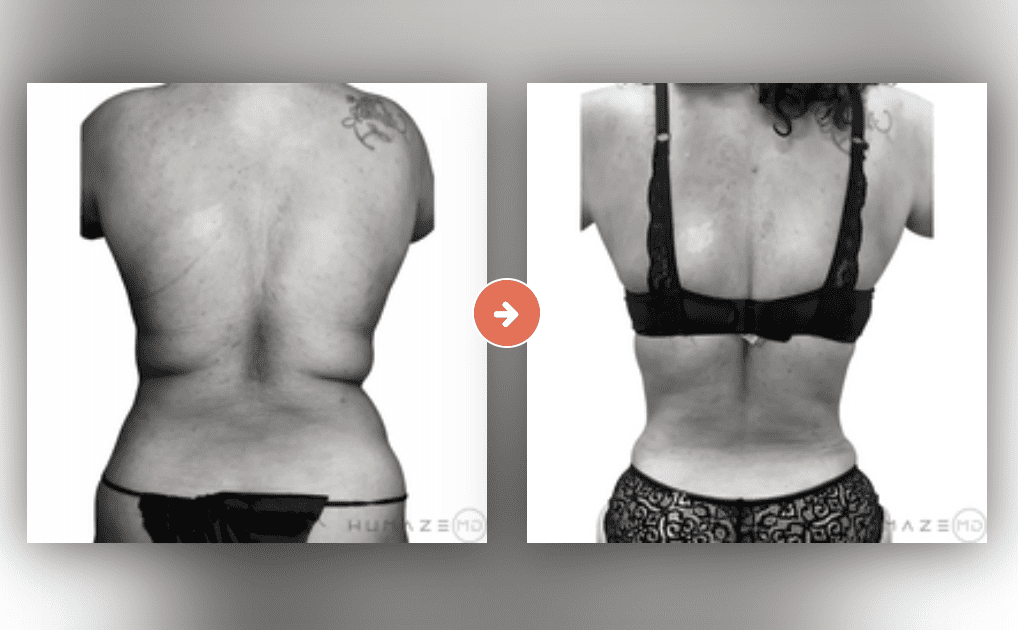 Screenshot 2023-10-12 at 6.51.54 PM Liposuction Before and After Pictures Charleston County, SC