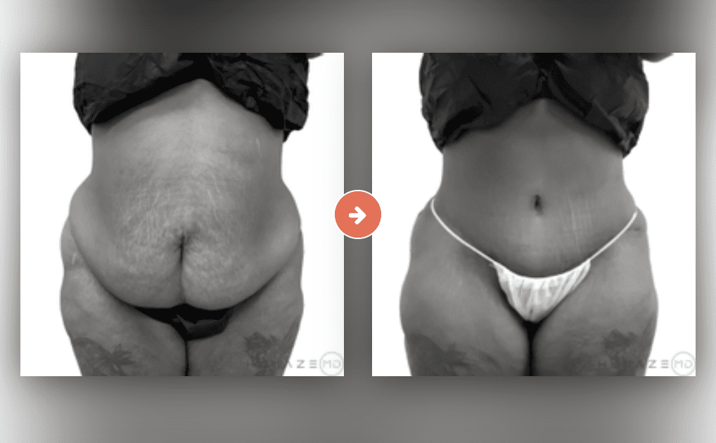 Screenshot 2023-10-12 at 6.54.51 PM Tummy Tuck Before and After Pictures Charleston County, SC