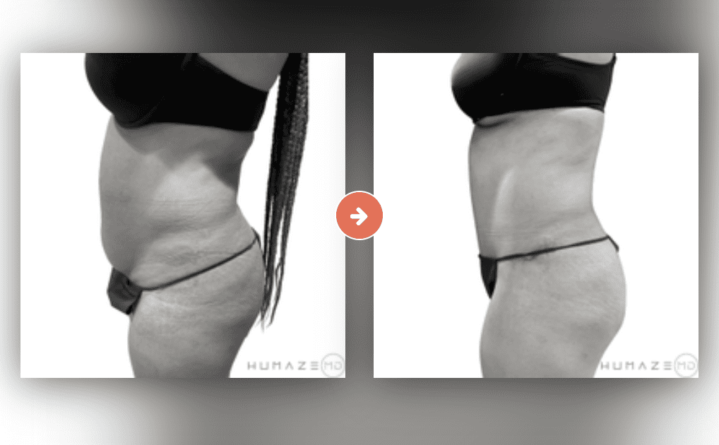 Screenshot 2023-10-12 at 6.55.13 PM Tummy Tuck Before and After Pictures Charleston County, SC