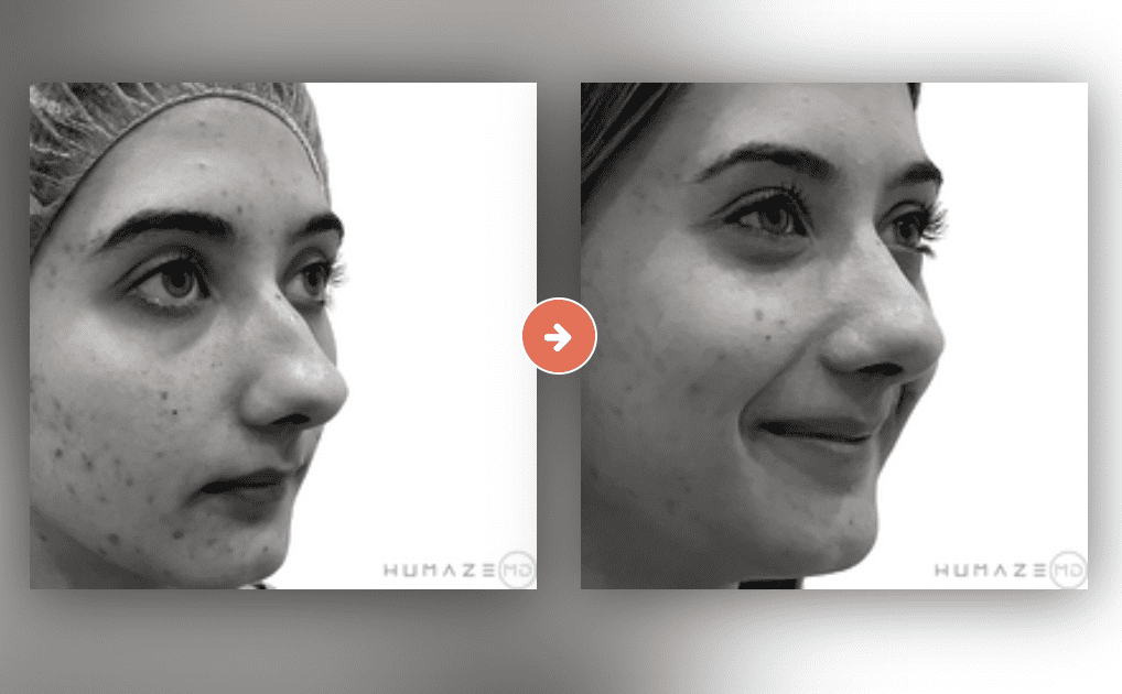 Screenshot 2023-10-12 at 7.08.51 PM Rhinoplasty Before and After Pictures Charleston County, SC