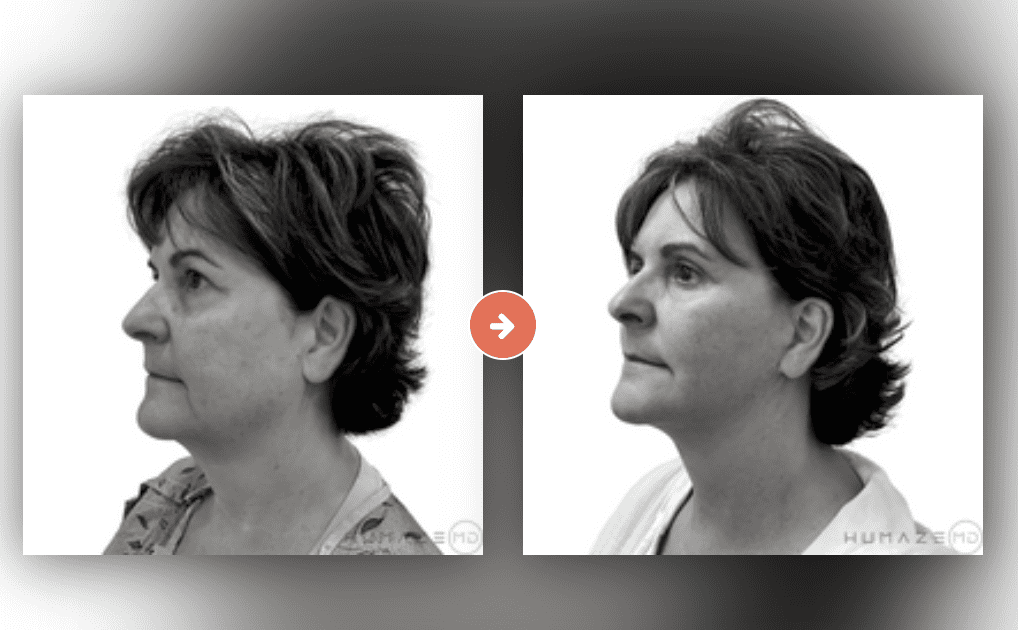 Screenshot 2023-10-12 at 7.09.35 PM Blepharoplasty (Eyelid Surgery) Before and After Pictures Charleston County, SC