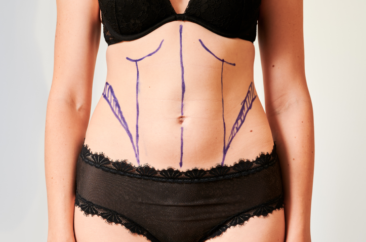 female-patient-body-with-marks-for-plastic-surgery-2023-11-27-04-54-00-utc Body Contouring in Charleston County, SC