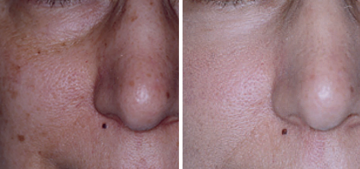 Screenshot 2024-10-11 at 9.16.05 PM Aerolase Laser Before and After Pictures Charleston County, SC