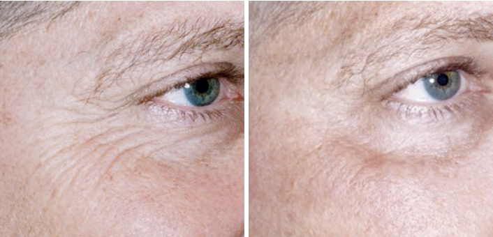 Screenshot 2024-10-11 at 9.15.55 PM Aerolase Laser Before and After Pictures Charleston County, SC