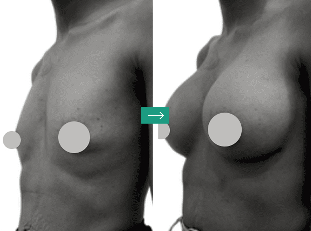 Breast Augmentation Aerolase Laser Before and After Pictures Charleston County, SC