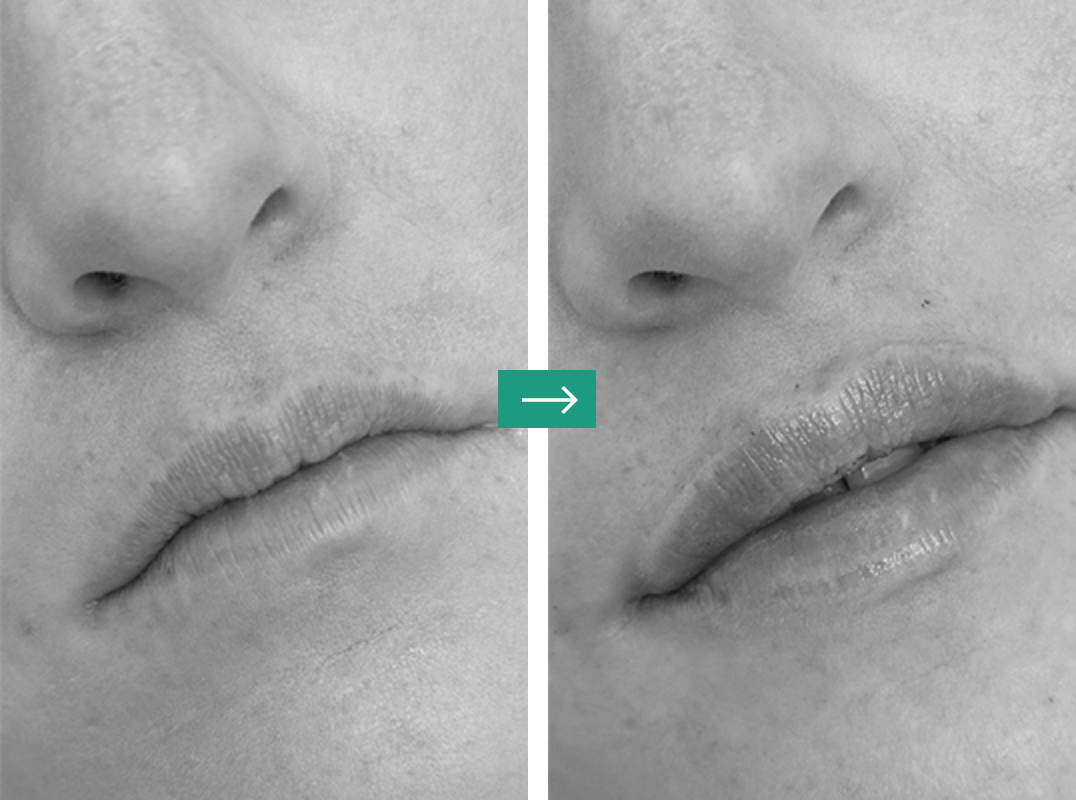 Dermal Fillers-img Aerolase Laser Before and After Pictures Charleston County, SC