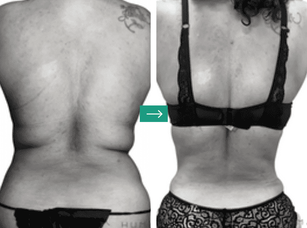 Liposuction-img Aerolase Laser Before and After Pictures Charleston County, SC