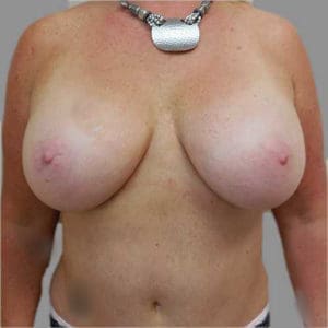 Breast Augmentation Before and After Pictures Charleston, SC