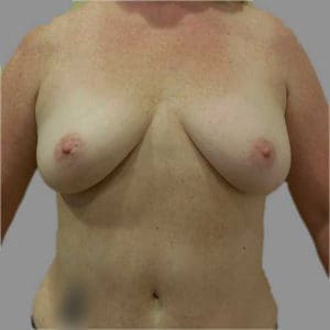 Breast Augmentation Before and After Pictures Charleston, SC