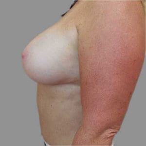 Breast Augmentation Before and After Pictures Charleston, SC