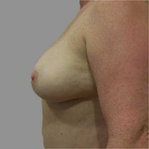 Breast Augmentation Before and After Pictures Charleston, SC