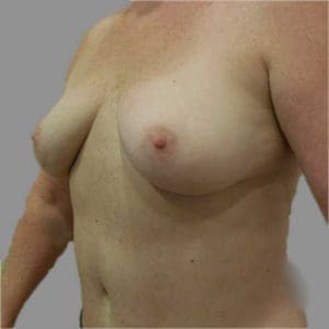 Breast Augmentation Before and After Pictures Charleston, SC