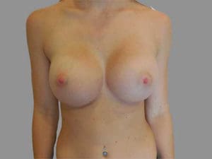 Breast Augmentation Before and After Pictures Charleston, SC