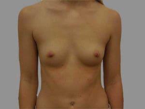 Breast Augmentation Before and After Pictures Charleston, SC