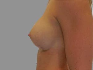 Breast Augmentation Before and After Pictures Charleston, SC