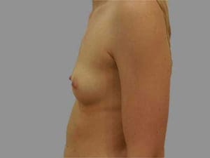 Breast Augmentation Before and After Pictures Charleston, SC