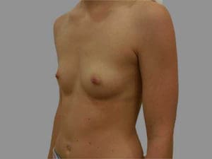 Breast Augmentation Before and After Pictures Charleston, SC