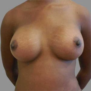 Breast Augmentation Before and After Pictures Charleston, SC