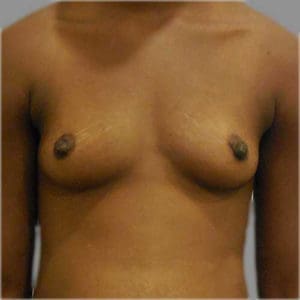 Breast Augmentation Before and After Pictures Charleston, SC