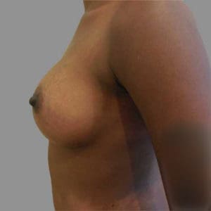 Breast Augmentation Before and After Pictures Charleston, SC