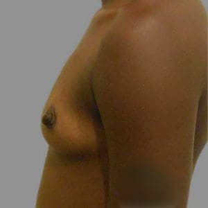 Breast Augmentation Before and After Pictures Charleston, SC