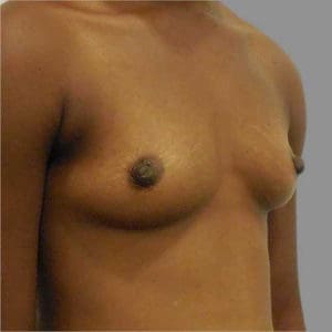 Breast Augmentation Before and After Pictures Charleston, SC