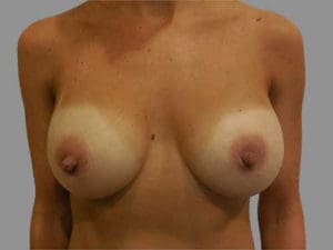 Breast Augmentation Before and After Pictures Charleston, SC