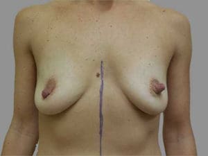 Breast Augmentation Before and After Pictures Charleston, SC