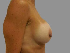 Breast Augmentation Before and After Pictures Charleston, SC