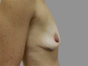 Breast Augmentation Before and After Pictures Charleston, SC