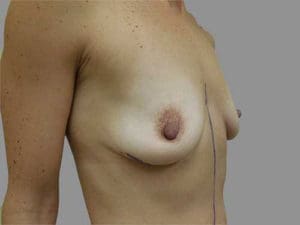 Breast Augmentation Before and After Pictures Charleston, SC