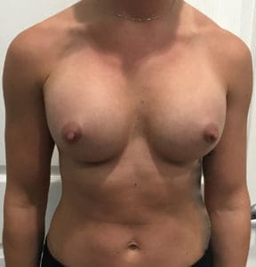 Breast Augmentation Before and After Pictures Charleston, SC