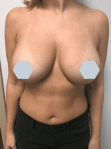 Breast Augmentation Before and After Pictures Charleston, SC