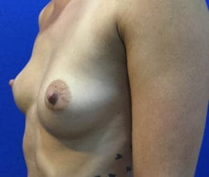 Breast Augmentation Before and After Pictures Charleston, SC
