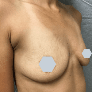 Breast Augmentation Before and After Pictures Charleston, SC