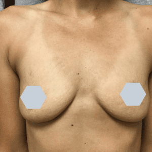 Breast Augmentation Before and After Pictures Charleston, SC