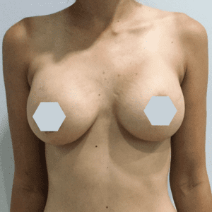 Breast Augmentation Before and After Pictures Charleston, SC