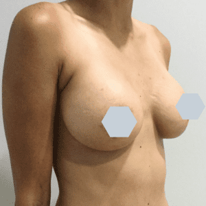 Breast Augmentation Before and After Pictures Charleston, SC