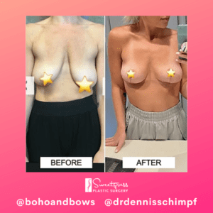Savannah @bohoandbows - Breast Lift Before and After Pictures in Charleston County, SC
