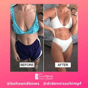 Savannah @bohoandbows - Mastopexy Before and After Pictures in Charleston County, SC