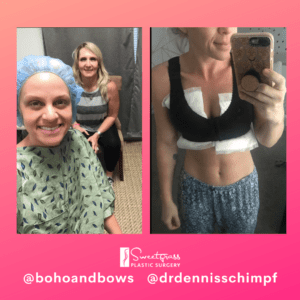Breast Lift Before and After Pictures in Charleston County, SC