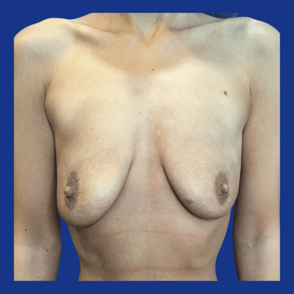 Breast Augmentation Before and After Pictures in Charleston County, SC