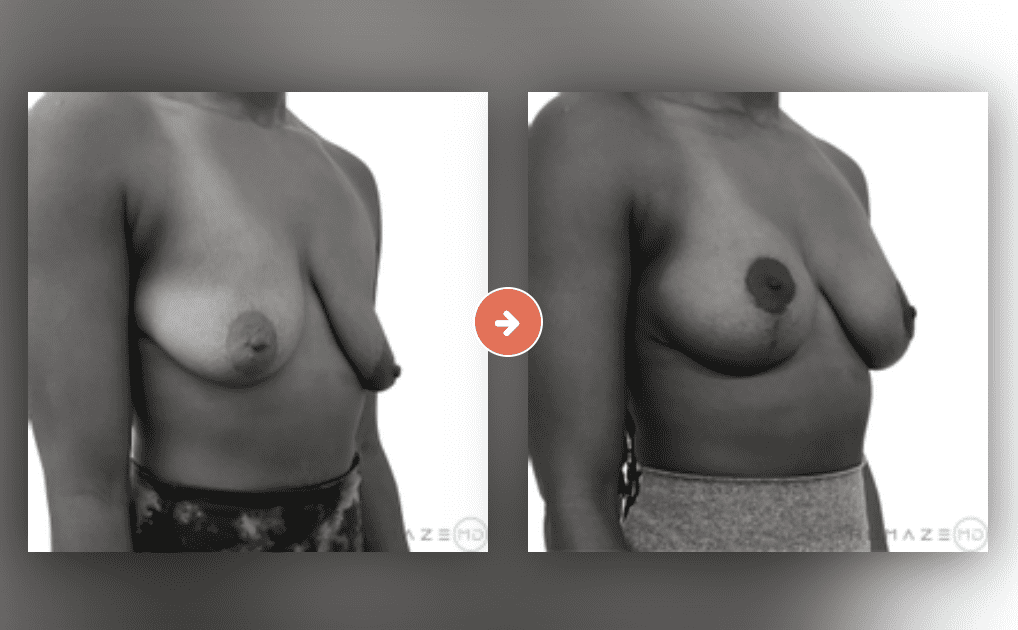 Breast Enhancement Before and After Pictures Charleston County, SC
