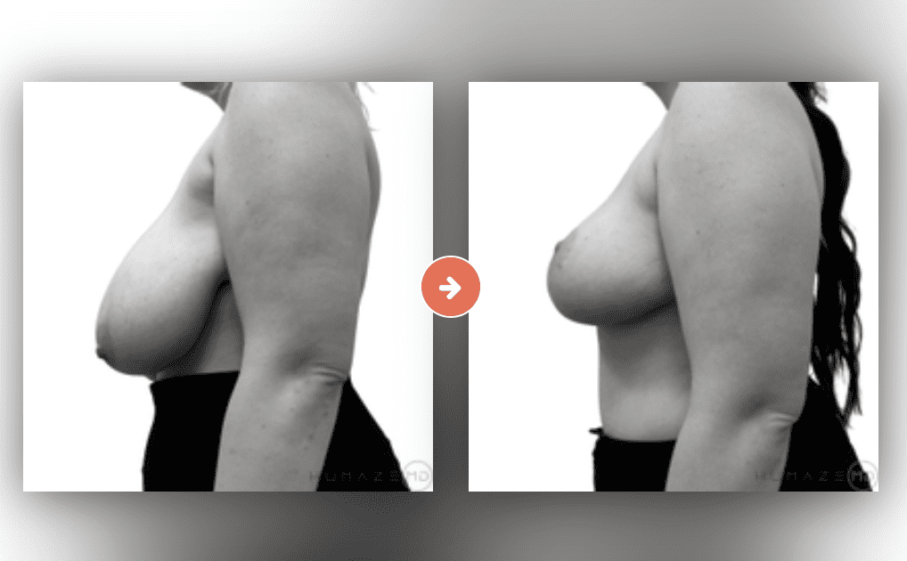 Breast Lift Before and After Pictures Charleston County, SC