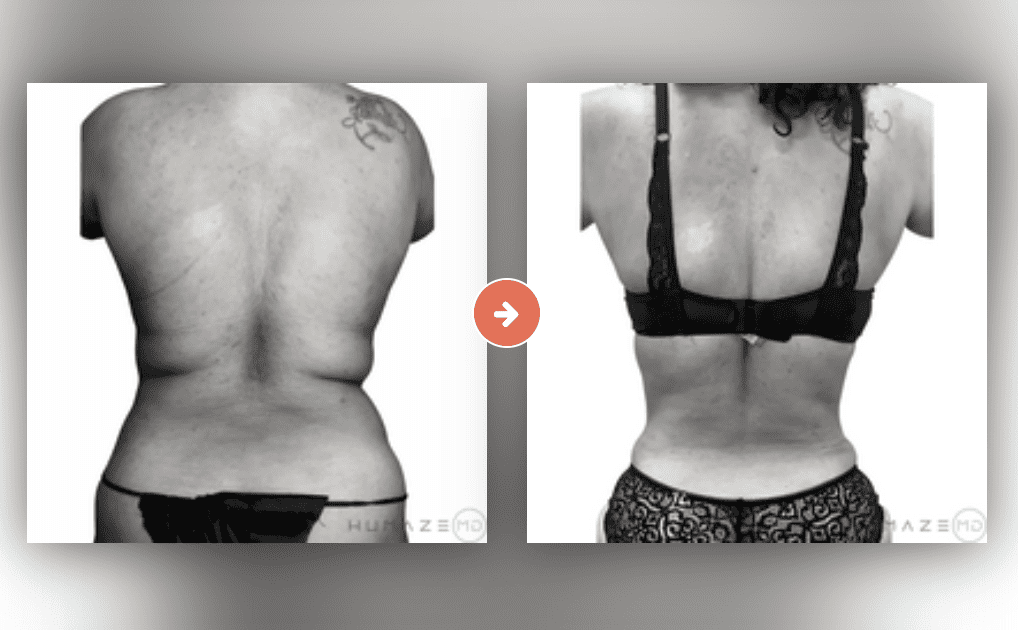 Liposuction Before and After Pictures Charleston County, SC