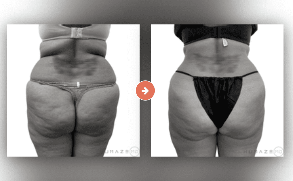 Liposuction Before and After Pictures Charleston County, SC