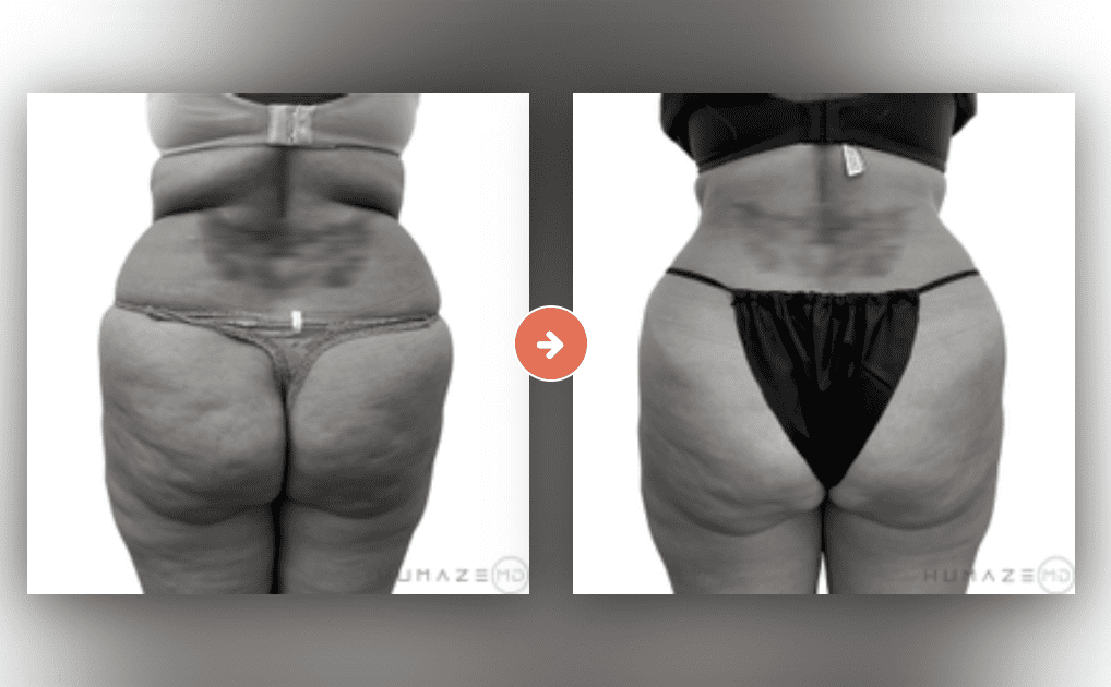 Screenshot 2023-10-12 at 6.52.35 PM Liposuction Before and After Pictures Charleston County, SC