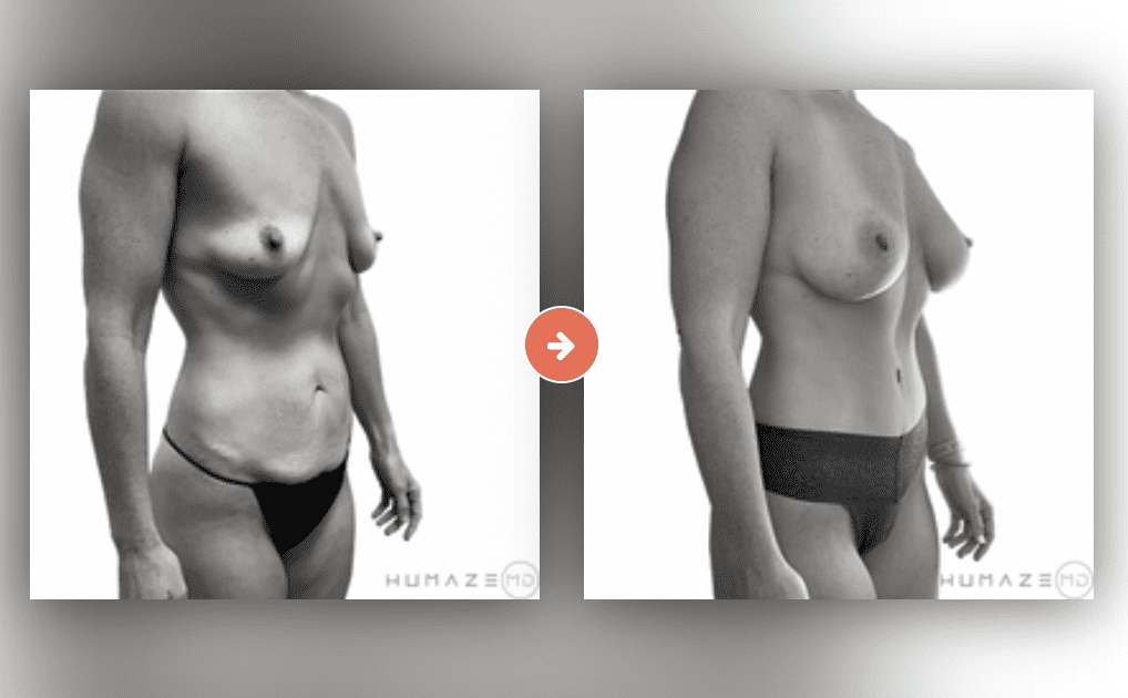 Screenshot 2023-10-12 at 6.52.56 PM Liposuction Before and After Pictures Charleston County, SC