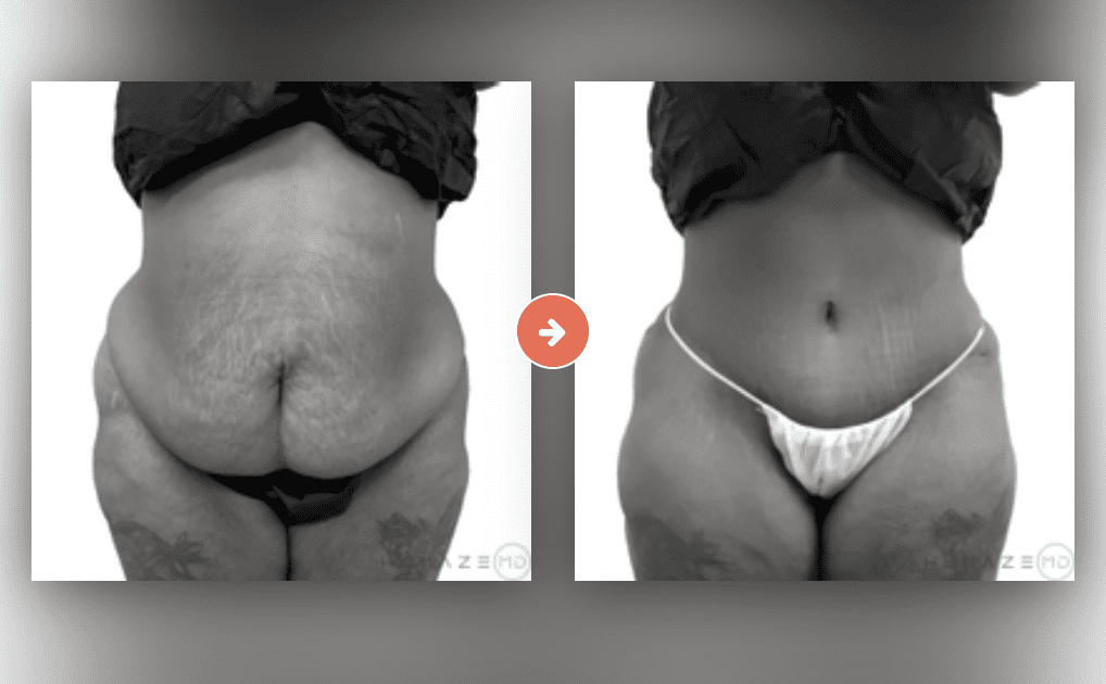 Tummy Tuck Before and After Pictures Charleston County, SC